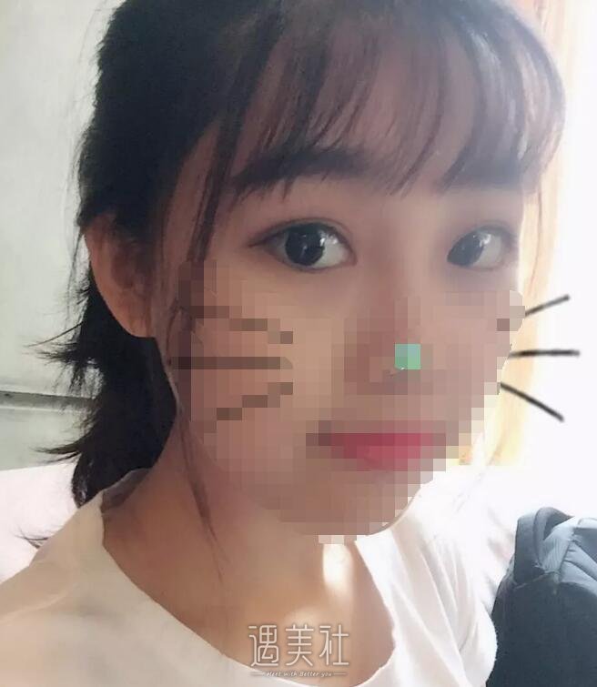 武警医院蒋亚楠给我做的双眼皮，目前恢复得灰常不错~