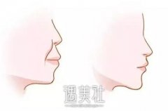 龅牙怎么矫正果比较好?龅牙矫正更快的方法是啥? width=