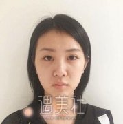 蒋亚楠鼻子做得怎么样?蒋亚楠隆鼻案例硬核力证呐! width=