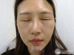 成都刘辅蓉双眼皮修复案例：修复大咖名不虚传呐! width=