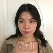 鼻部手术术后1-7天的照片分享：颜值真的有提升几个level~ width=