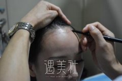 韩国卢相勋植发技术怎么样?有真实案例吗想看看! width=