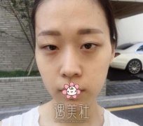 沈莺莺双眼皮修复技术好吗？有真实案例吗想看看喃！ width=