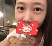 找张永义医生割了双眼皮，颜值简直是质的飞越啊~ width=