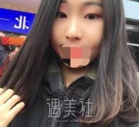 沈阳协和医院做双眼皮案例：价格不便宜但果很满意! width=