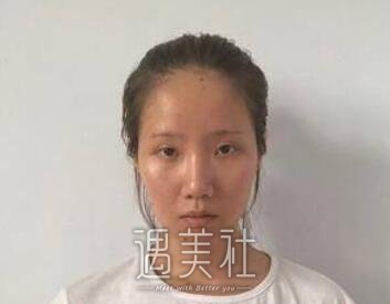 徐永安,面部填充
