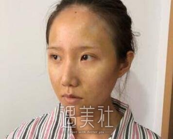 徐永安,面部填充