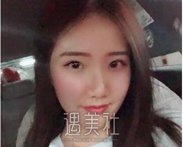 徐永安,面部填充
