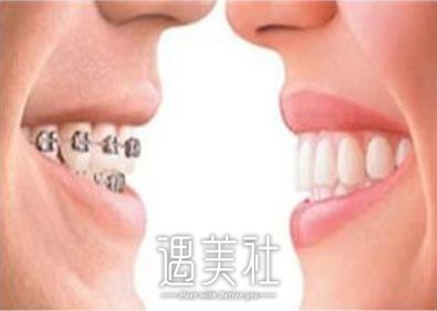 矫正牙齿
