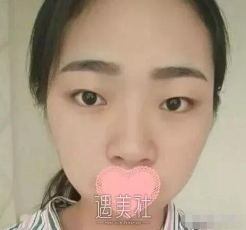 钱云良做双眼皮怎么样|钱云良双眼皮案例硬核来袭~