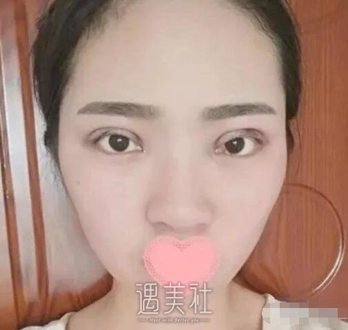 钱云良做双眼皮怎么样|钱云良双眼皮案例硬核来袭~