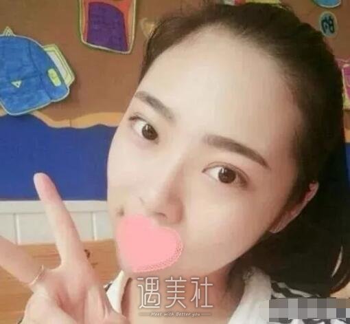 钱云良做双眼皮怎么样|钱云良双眼皮案例硬核来袭~
