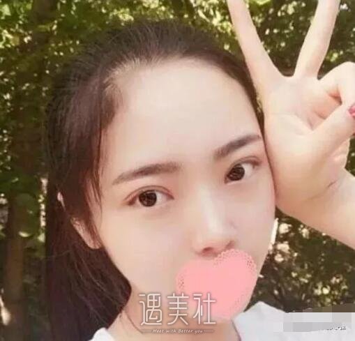 钱云良做双眼皮怎么样|钱云良双眼皮案例硬核来袭~