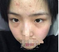 霍孟华医生光子嫩肤技术怎么样，有近期案例给看看嘛? width=