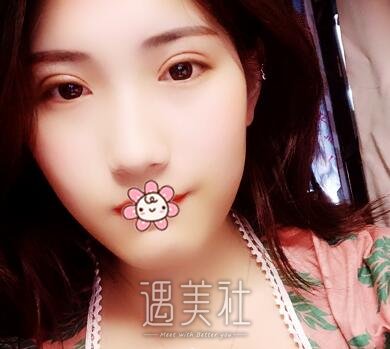 曹卫刚,割双眼皮