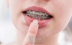 成都成年牙齿矫正多少钱，听说这个项目真的贵~ width=