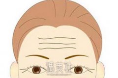 去除抬头纹的方法有哪些呢?一起盘点抬头纹去除方法~ width=