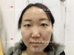 谢洋春双眼皮案例：终于不用每天“眯着眼”了~ width=