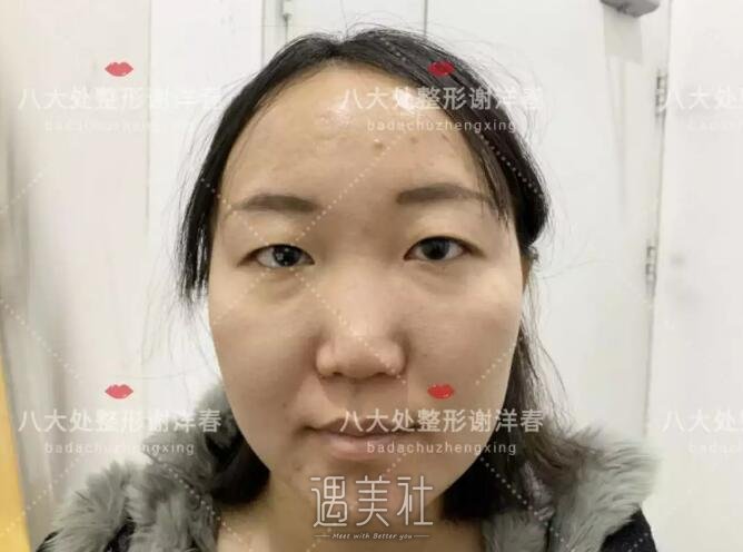 谢洋春双眼皮案例：终于不用每天“眯着眼”了~
