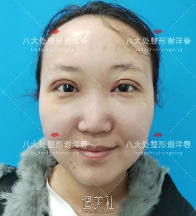 谢洋春双眼皮案例：终于不用每天“眯着眼”了~