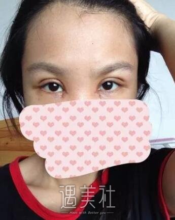 杨明勇双眼皮案例：早就有耳闻杨医生做双眼皮很牛皮~