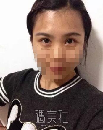 杨明勇双眼皮案例：早就有耳闻杨医生做双眼皮很牛皮~