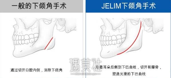 广州下颌角磨骨价格多少钱，有很多人动不动就上万了?