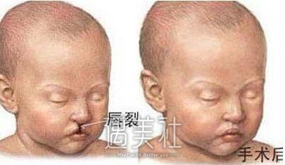 成都兔唇手术多少钱，收费影响因素有哪些?