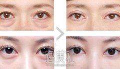 长春超声波乳化去眼袋果怎么样，能有去除眼袋吗? width=