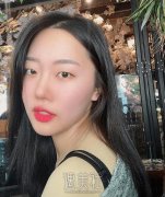 上海九院董佳生医生双眼皮案例：大眼睛的我猜好看嘛! width=
