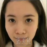 范飞隆鼻案例：公立医院的医生技术果然黑不错啊! width=