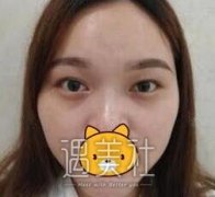 马继光双眼皮案例：表姐看了都羡慕我的大眼~ width=