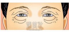 兰州注射瘦脸去鱼尾纹有没有后遗症，具体有哪些? width=
