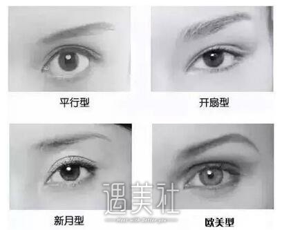 欧式双眼皮多少钱