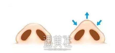 鼻头缩小手术
