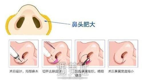 鼻头缩小手术