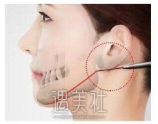 重庆下颌角磨骨需要多少钱，在什么范围比较合理! width=