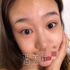 张余光