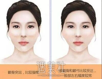 深圳,颧骨内推
