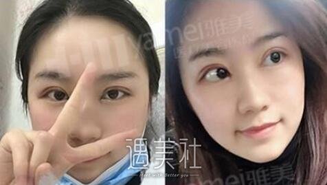 雅美,田芳斌,双眼皮