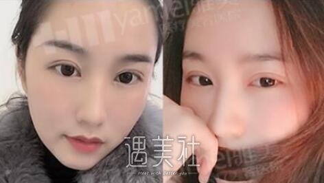 雅美,田芳斌,双眼皮