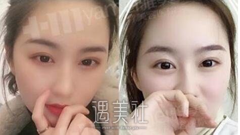 雅美,田芳斌,双眼皮