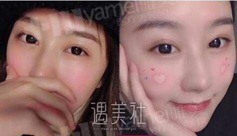 雅美,田芳斌,双眼皮