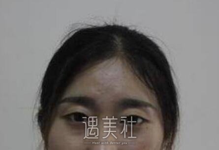 刘珍君,双眼皮