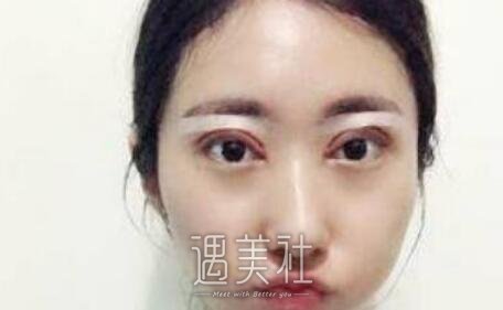 刘珍君,双眼皮