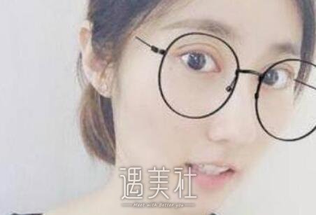 刘珍君,双眼皮