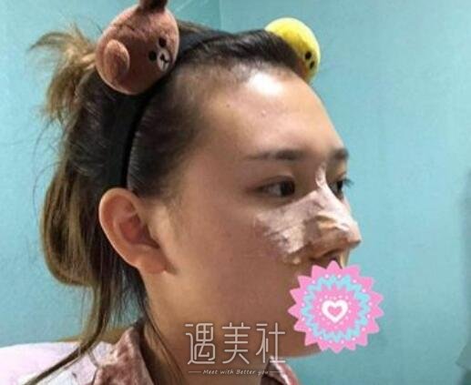巫文云,鼻子