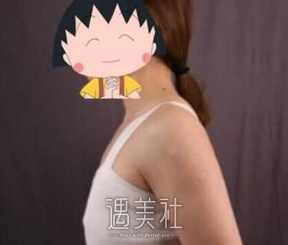 曹卫刚,自体脂肪隆胸