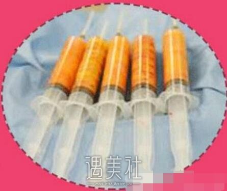 曹卫刚,自体脂肪隆胸