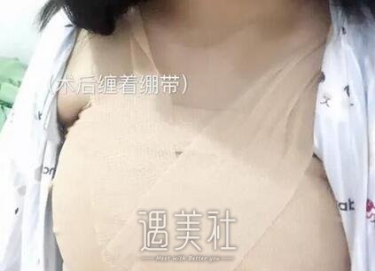 曹卫刚,自体脂肪隆胸